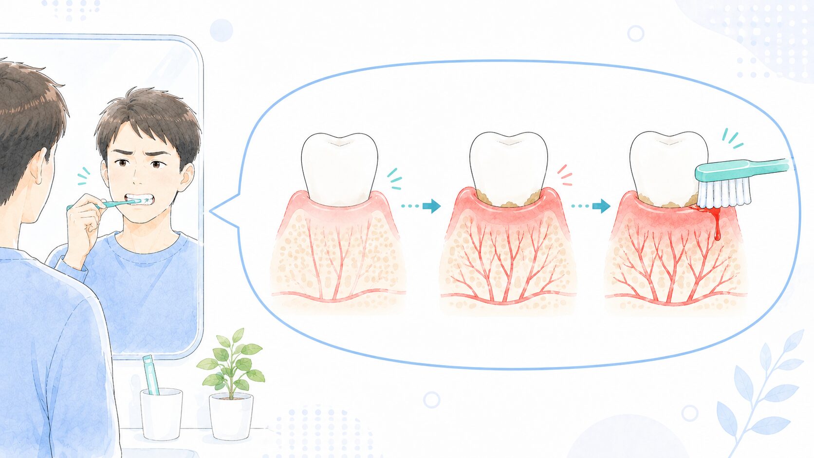 歯ぐきの炎症で血管が広がり刺激で出血する仕組みのイラスト