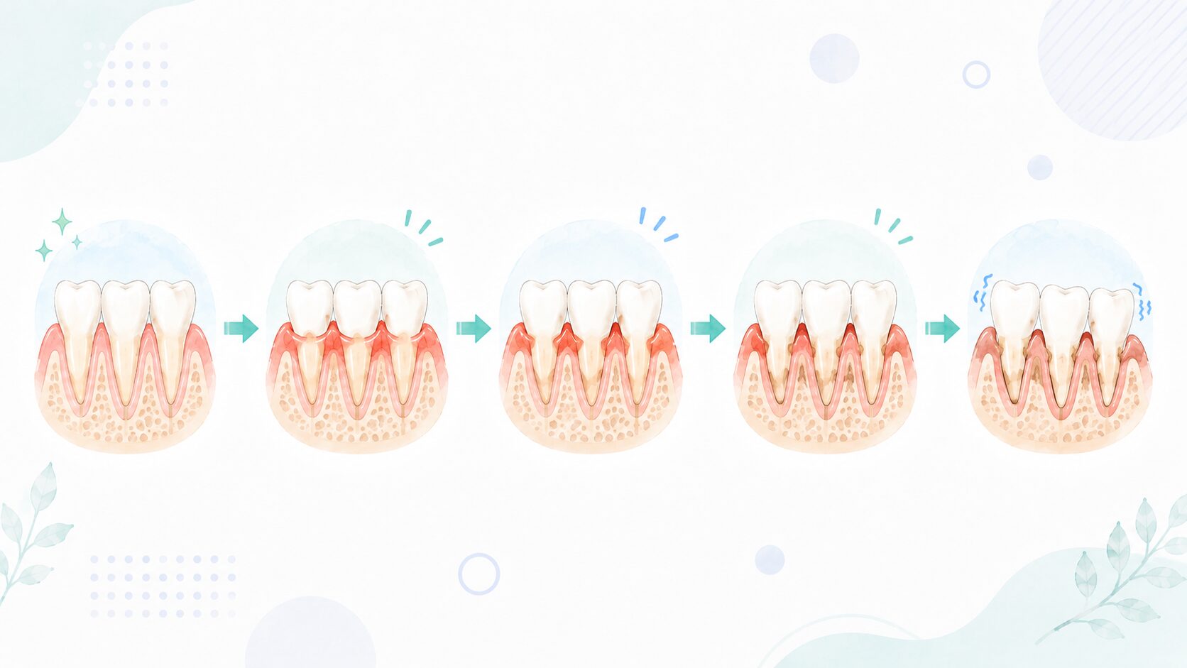 放置すると歯周病が進行していく歯ぐきの断面イラスト