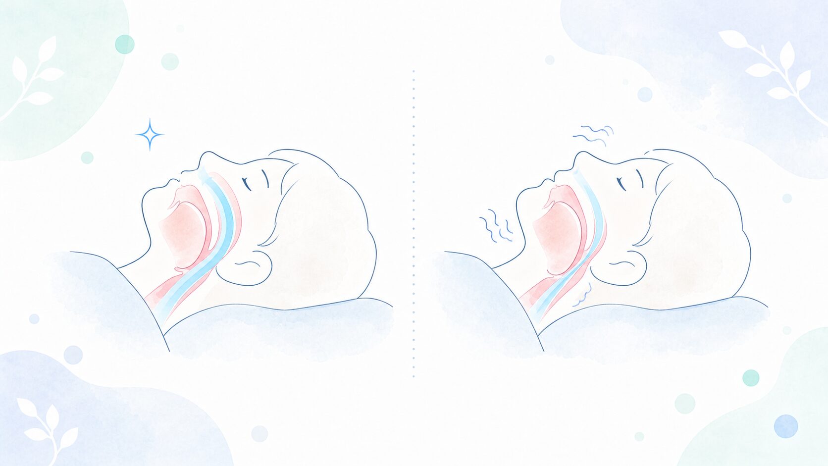 気道が確保された状態と、舌が落ち込んで気道が狭くなった状態を比べたイラスト