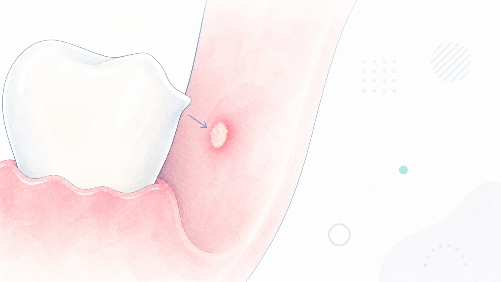 尖った歯が頬の粘膜に当たって口内炎ができるイラスト