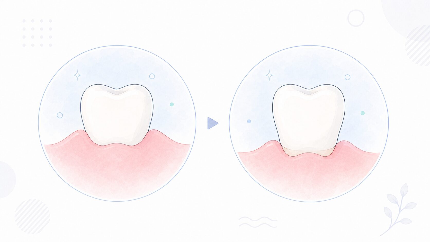 健康な歯茎と下がった歯茎を比べたイラスト