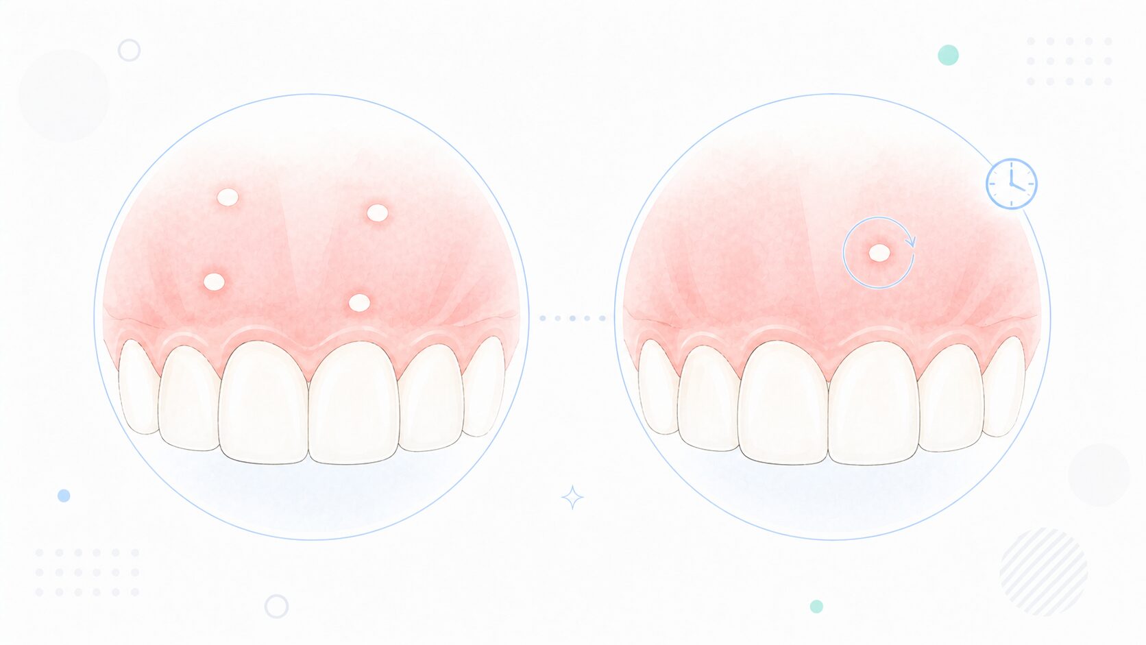 口内炎が同時にたくさんできる状態と、繰り返しできる状態の比較イラスト